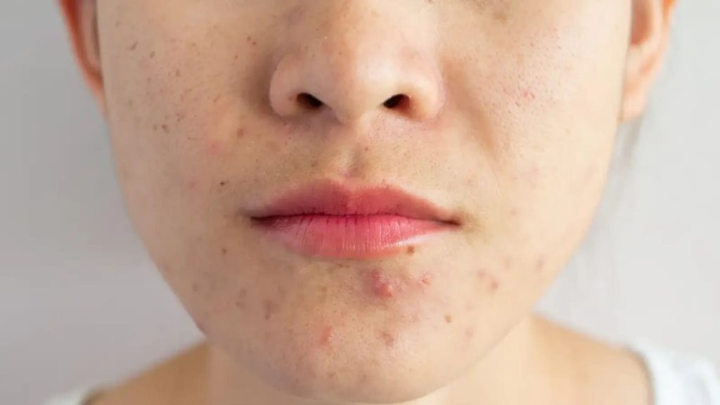 5 skincare hacks to fight acne during season change