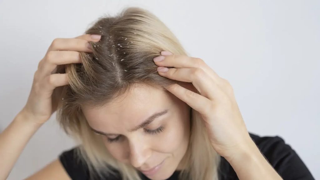 6 quick fixes for oily, sticky dandruff and a flake-free scalp