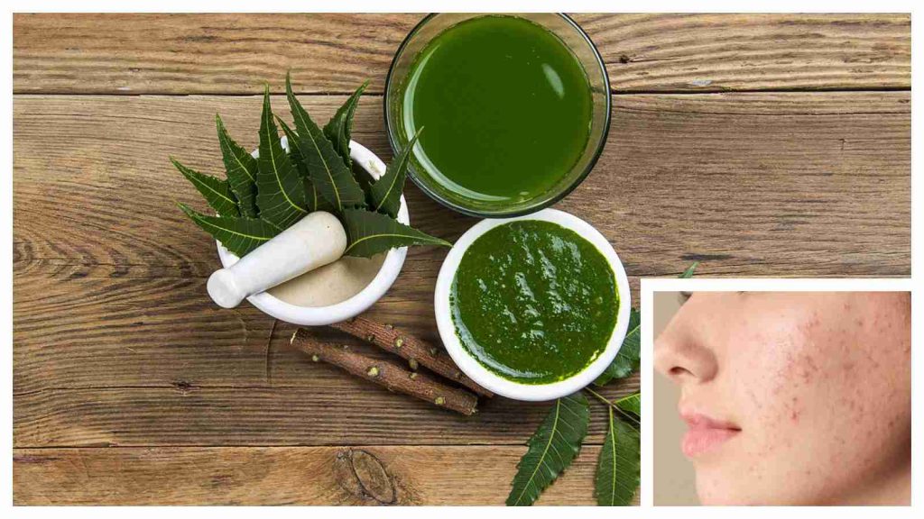 How to use neem for acne and pimples without wrecking your skin