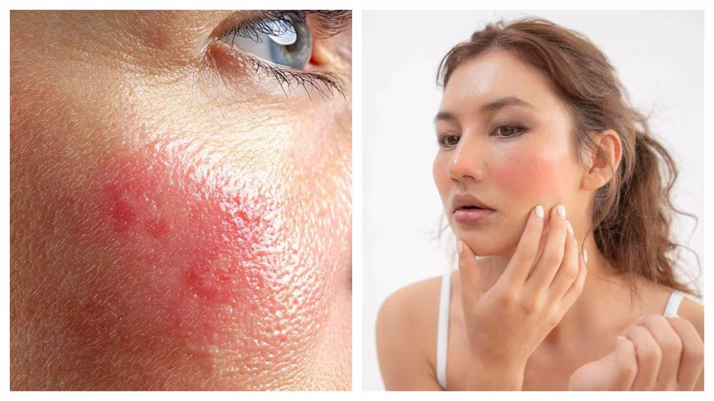 Skin allergies: Why they return and how to restore your skin barrier