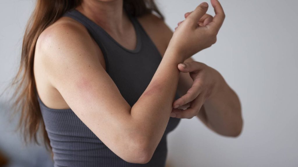 Winter rash vs. eczema: Symptoms, treatments, and skincare tips